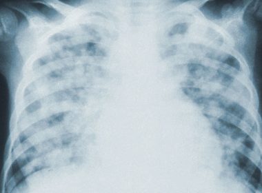 Researchers Find Extensive Lung Damage in COVID-19 Corpses